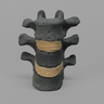 Thoracic, T10-T12, Osteoporotic Vertebrae