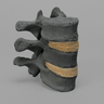 Thoracic, T10-T12, Osteoporotic Vertebrae