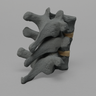 Thoracic, T10-T12, Osteoporotic Vertebrae