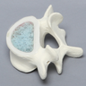 Vertebra, L5, Osteoporotic with Window, Foam Cortical