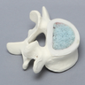 Vertebra, L5, Osteoporotic with Window, Foam Cortical