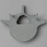 Vertebra, L5, Radiopaque