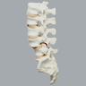 Spine, Lumbar with L4 Spondylolisthesis, Solid Foam
