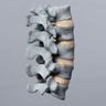 Spine, Lumbar, L1-L5, Osteoporotic Vertebrae, Radiopaque