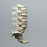 Spine, Lumbar, with L5-Sacrum Grade III Spondylolisthesis