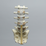 Spine, Lumbar, with L5-Sacrum Grade III Spondylolisthesis