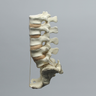 Spine, Lumbar, with L5-Sacrum Grade III Spondylolisthesis