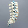 Spine, Lumbar, with L5 Stenosis, Foam Cortical