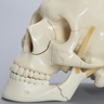 Skull, Full, With Multiple Fractures