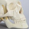 Skull, Full, With Le Fort II, Zygomatic, and Mandible Fractures