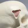 Skull with Fracture and Craniotomies