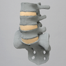 Spine, Lumbar, L3-Sacrum, Radiopaque