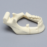 Mandible with Bilateral Fractures