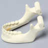 Mandible with Solid Teeth and Sagittal Fracture