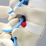 Spine, Lumbar, Herniated Disc, Solid Foam