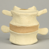 Lumbar Vertebrae, L4-L5, with Stenosis, Solid Foam