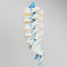 Spine, Lumbar with L3-L5 Stenosis, Solid Foam