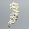 Spine, Lumbar with Laminectomy, Solid Foam