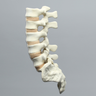 Spine, Lumbar with Laminectomy, Solid Foam