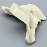 Hemi Pelvis with Wall Fractures, Solid Foam, Right