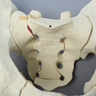 Pelvis with Sacral, Acetabular, and Column Fractures, Full Male, Foam Cortical