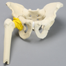 Pelvis with Acetabular Fractures, Fragment, and Femur, Full Male