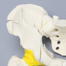 Pelvis with Both Column Fracture and Encapsulated Femur, Full Male