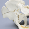 Pelvis with Both Column Fracture and Encapsulated Femur, Full Male