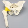 Pelvis with "T" Fracture, Displacement, and Encapsulated Femur, Full Male