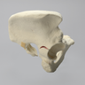 Pelvis with Disruption and Wall Fractures, Full Male, Solid Foam