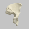 Hemi Pelvis, Female, Solid Foam, With Dysplasia, Left