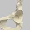 Hemi Pelvis, Female, Solid Foam, With Dysplasia, Left