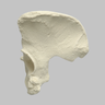 Hemi Pelvis, Female, Solid Foam, With Dysplasia, Left