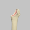 Femur with Focal Deficiency Type 1
