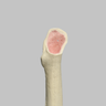 Femur with Focal Deficiency Type 1