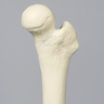 Femur with 155 Degree Neck Deformity