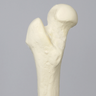 Femur with 155 Degree Neck Deformity