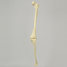 Knee with Distal Femur 40 Degree Hypoplastic Condyle Defect