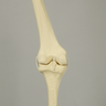 Knee with Distal Femur 40 Degree Hypoplastic Condyle Defect
