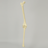 Knee with Distal Femur 10 Degree Valgus Deformity