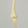 Knee with Distal Femur 10 Degree Valgus Deformity