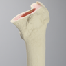 Femur with Broached and Cemented Proximal Cavity