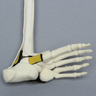 Foot and Ankle, with Clubfoot and Ligaments, Pediatric