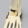 Foot and Ankle with Vertical Talus Pathology, Pediatric