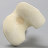 Femur with Distal Malunion and 35 Degree Rotation
