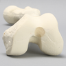 Femur with 10 Degree Valgus Deformity