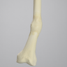 Femur with Distal Malunion and 45 Degree Rotation