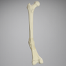 Femur with Distal Malunion and 45 Degree Rotation