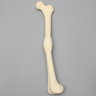 Femur with Midshaft Malunion and Anteversion