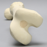 Femur with Midshaft Malunion and Anteversion